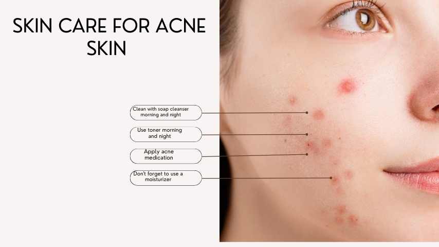 Home Remedies for Acne in Pakistan: Natural Solutions for Clear Skin